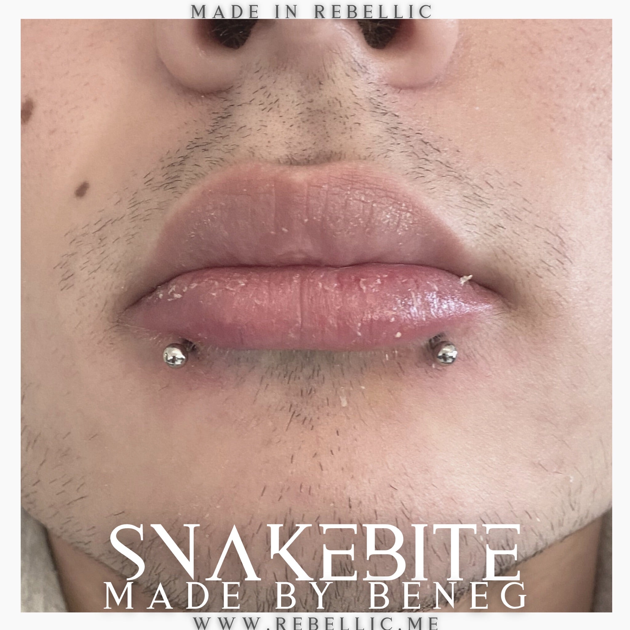Snakebite